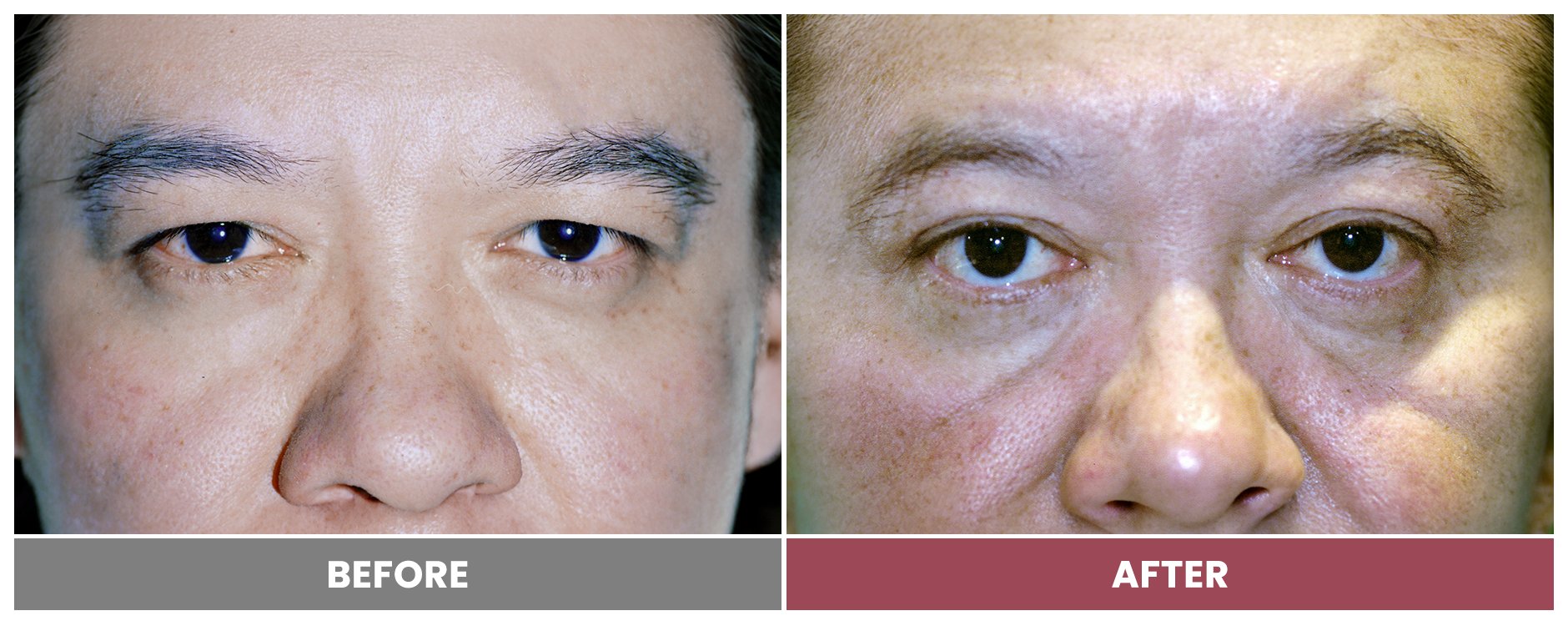 Upper Blepharoplasty - Case 43